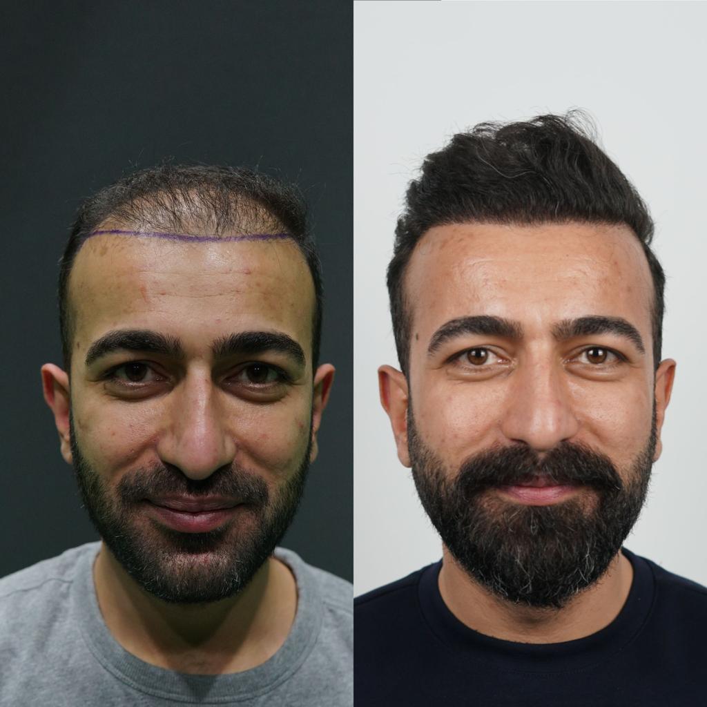 prima e dopo trapianto capelli 4